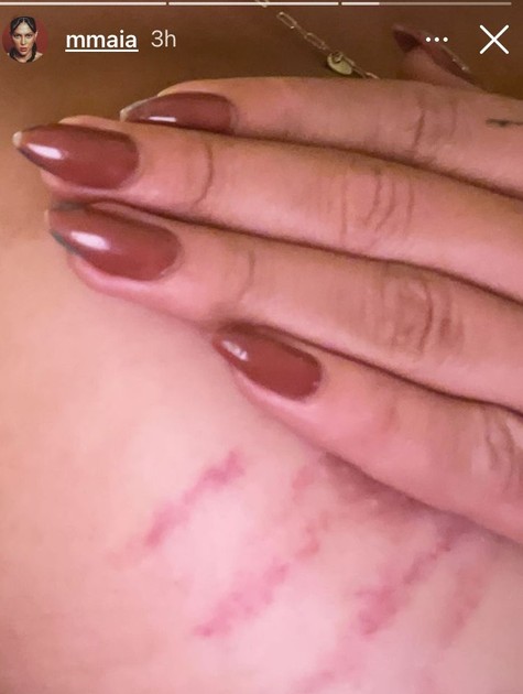 Atriz Marcella Maia mostra denuncia transfobia e mostra hematomas 1