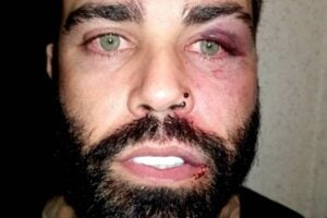 Cantor sertanejo Warley Carvalho com o rosto machucado