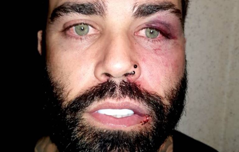 Cantor sertanejo Warley Carvalho com o rosto machucado