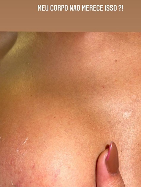 Atriz Marcella Maia mostra denuncia transfobia e mostra hematomas 3