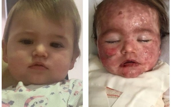 Helena antes e depois da reação rara