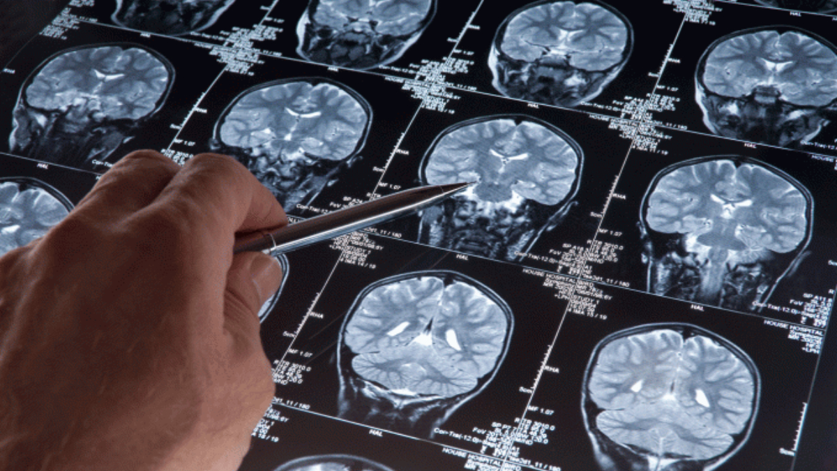 Pacientes com Alzheimer têm até 6 vezes mais risco de contraírem Covid-19 grave