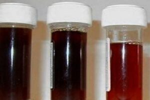 doença de Haff Neste sábado, três casos da doença de Haff foram notificados em Santarém, Amazonas. Doença da urina preta: casos afetam ao menos três estados