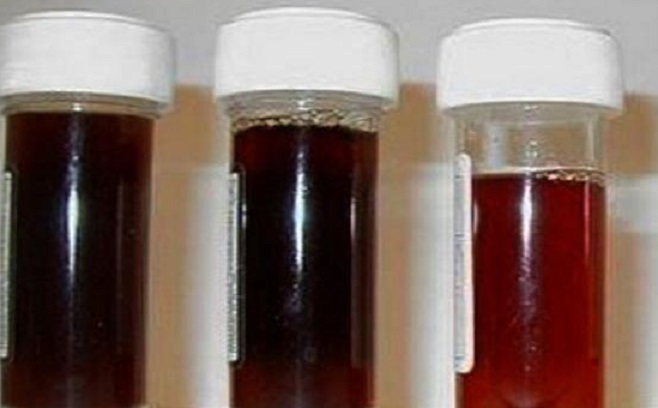 doença de Haff Neste sábado, três casos da doença de Haff foram notificados em Santarém, Amazonas. Doença da urina preta: casos afetam ao menos três estados