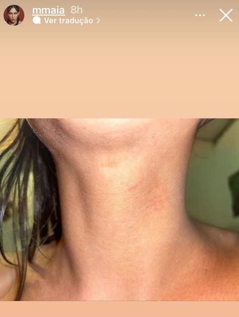 Atriz Marcella Maia mostra denuncia transfobia e mostra hematomas 2