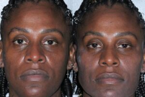 'Um dos nossos sonhos', comemoram Pepê e Neném a realização de harmonização facial