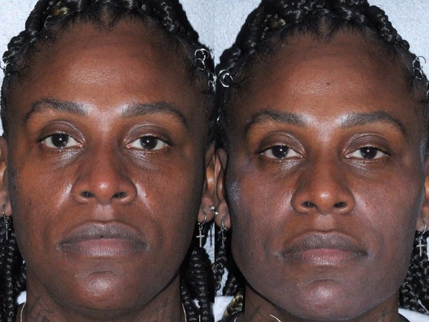 'Um dos nossos sonhos', comemoram Pepê e Neném a realização de harmonização facial