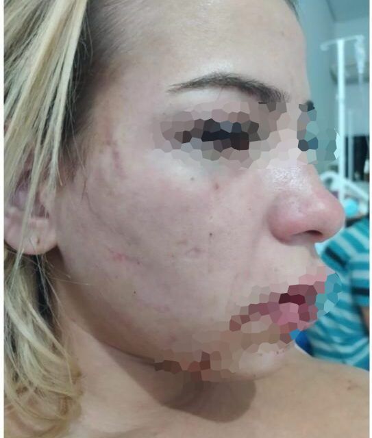 Mulher que sofreu agressão teve fraturas no rosto vai precisar passar por uma cirurgia (Foto: Arquivo pessoal)