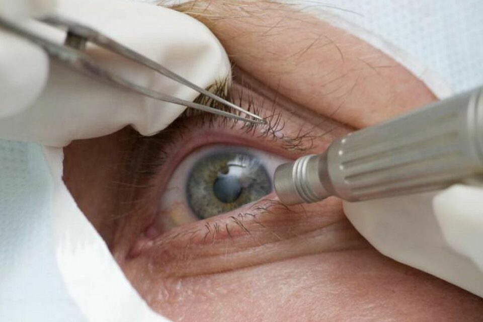 procedimento ocular