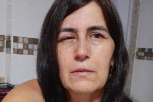 Mulher é socorrida após confundir supercola com colírio, no ES