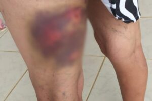 Após três ataques de cachorro em dois meses, idosa denuncia dono à polícia em Goiânia