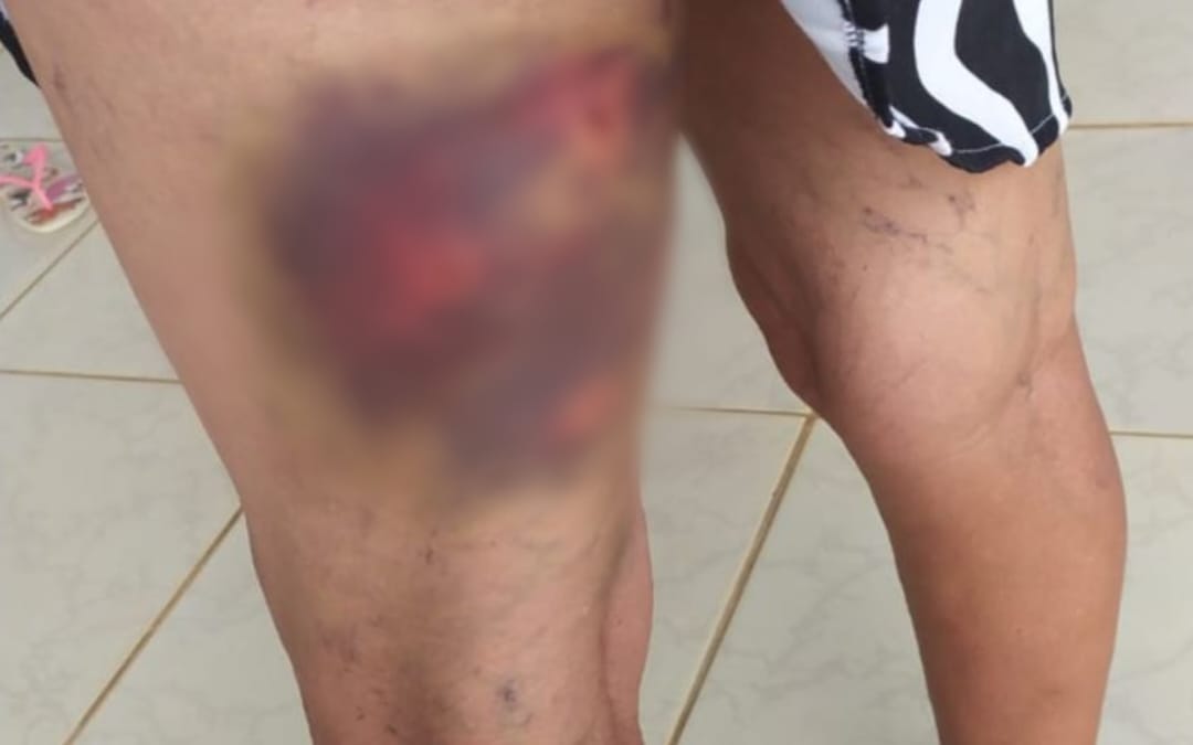 Após três ataques de cachorro em dois meses, idosa denuncia dono à polícia em Goiânia