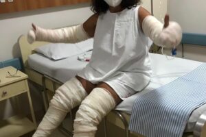 Queimaduras mulher Anápolis