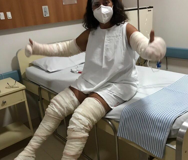 Queimaduras mulher Anápolis