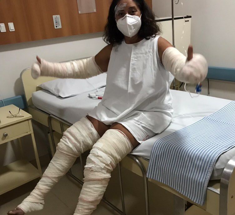 Queimaduras mulher Anápolis