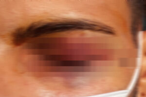 Vítima de suposta agressão da PM passa por cirurgia para reconstruir pálpebra em Goiânia