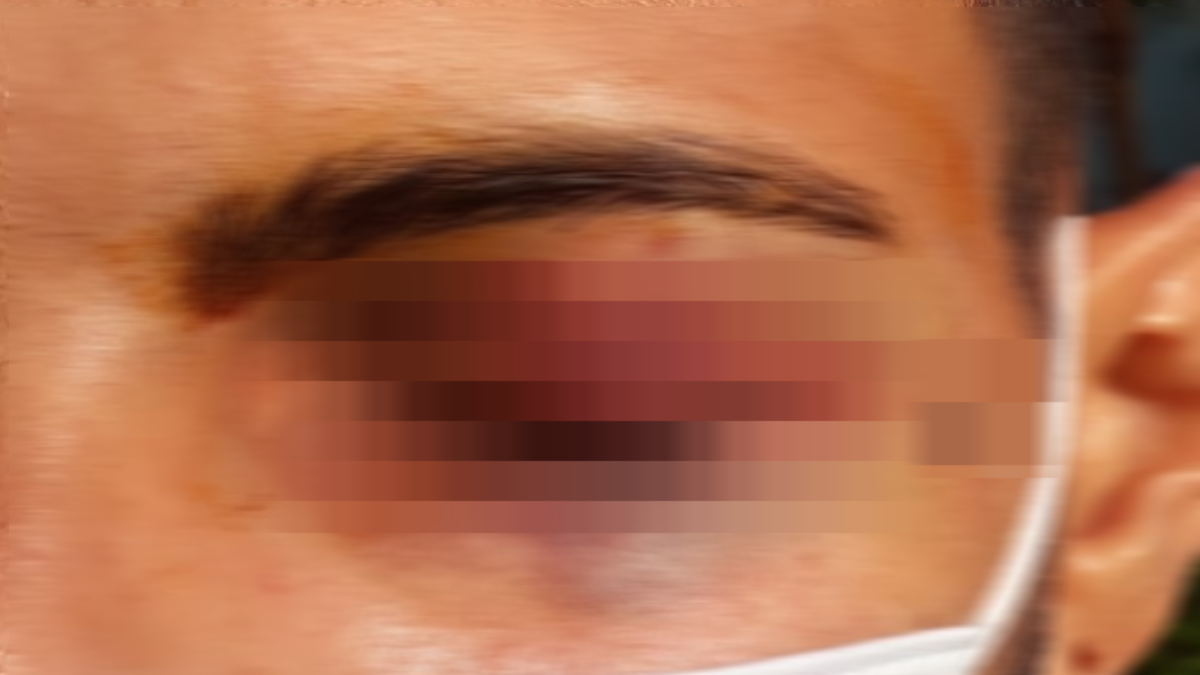 Vítima de suposta agressão da PM passa por cirurgia para reconstruir pálpebra em Goiânia