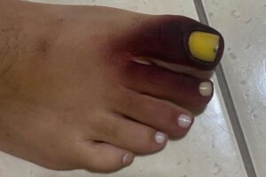 Mulher publicou o estado do pé nas redes sociais ao ser picada por um piolho-de-cobra