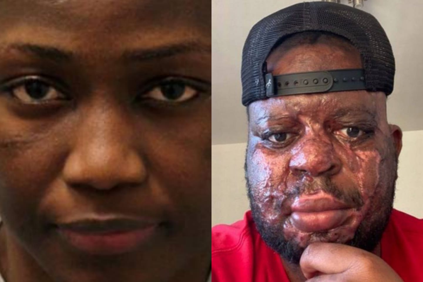 Mulher é condenada por jogar ácido no rosto do namorado por achar que estava sendo traída, mas estava enganada