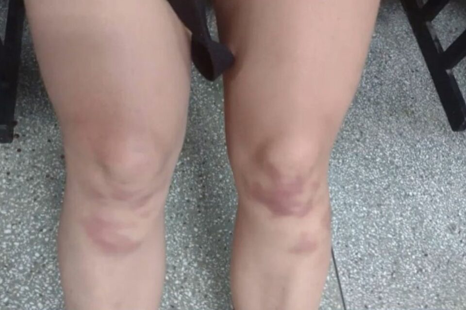 Mulher conta com várias marcas de agressão pelo corpo