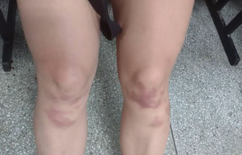 Mulher conta com várias marcas de agressão pelo corpo