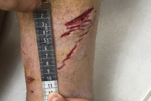 Turista francês é atacado por tubarão no litoral de SP