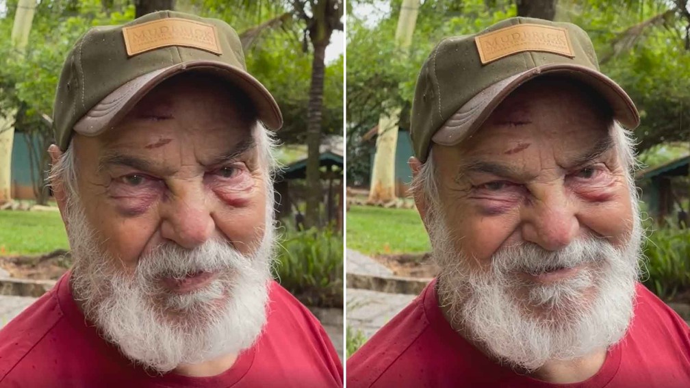 Lima Duarte machuca rosto após acidente doméstico