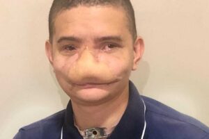 "Foi como um soco", diz jovem que perdeu nariz ao ser atingido por fogos em Caldas Novas