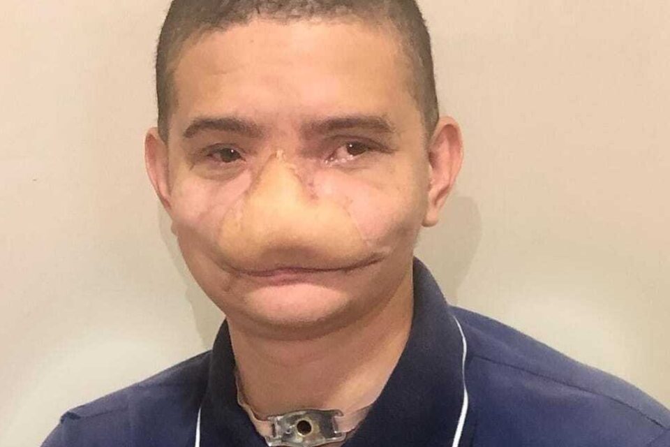 "Foi como um soco", diz jovem que perdeu nariz ao ser atingido por fogos em Caldas Novas