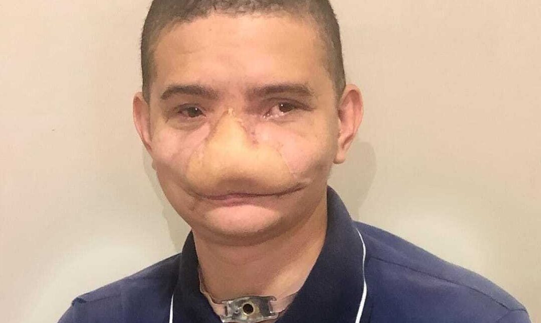 "Foi como um soco", diz jovem que perdeu nariz ao ser atingido por fogos em Caldas Novas