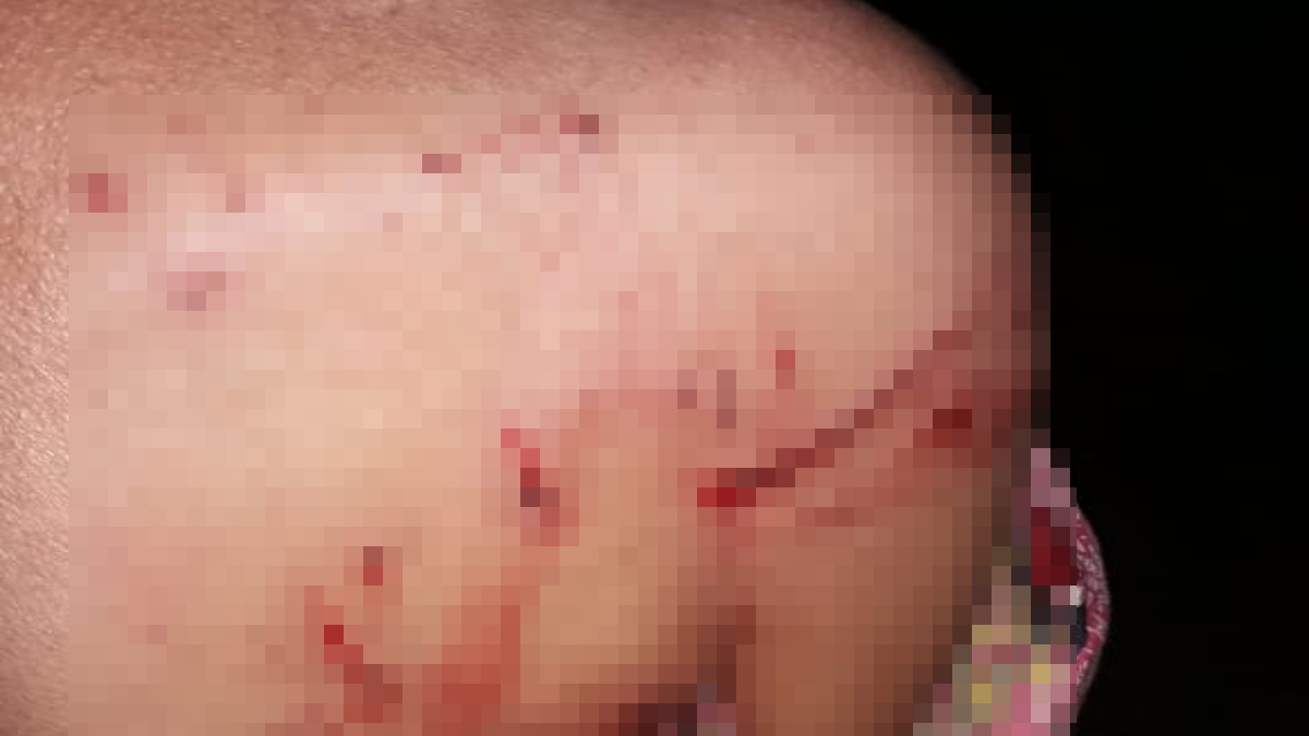 Idosa fica ferida após quarto ataque de pitbull em cinco meses, em Goiânia