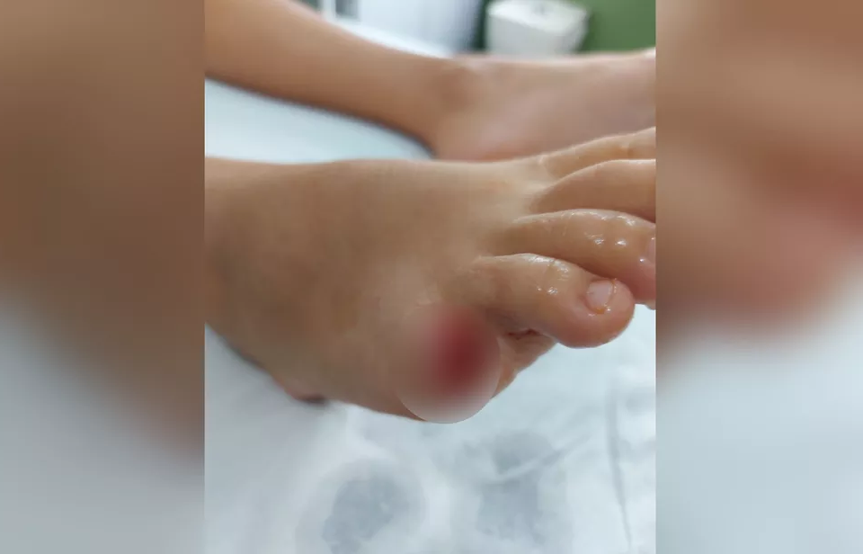Criança de 10 anos tem o dedo arrancado por piranha em lago de Buriti Alegre