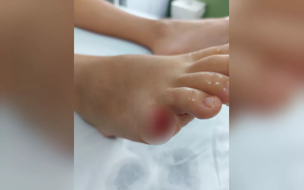 Criança de 10 anos tem o dedo arrancado por piranha em lago de Buriti Alegre