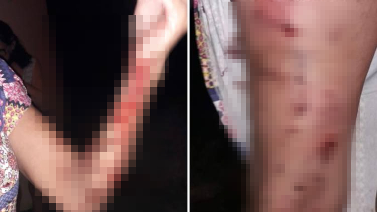 Idosa fica ferida após quarto ataque de pitbull em cinco meses, em Goiânia