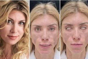 Yulia Tarasevich diz que chegou bonita e saudável e saiu desfigurada. Rússia: conheça a miss que não fecha os olhos nem sorri após plásticas