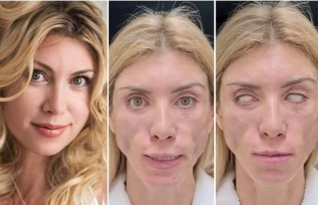 Yulia Tarasevich diz que chegou bonita e saudável e saiu desfigurada. Rússia: conheça a miss que não fecha os olhos nem sorri após plásticas