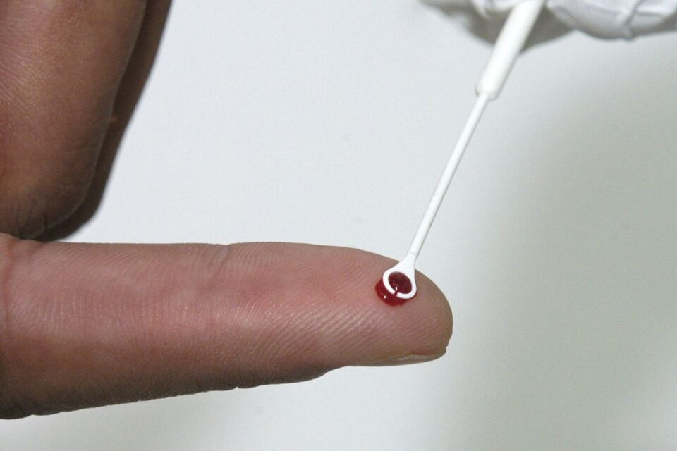 Com procedimento, o vírus regrediu na paciente; caso foi publicado na revista Cell Mulher é curada do HIV após transplante de células-tronco