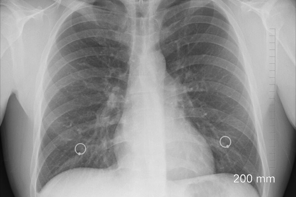 Estudo detecta lesões pulmonares ocultas em Covid longa