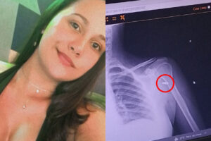 Mulher leva tiro de raspão e só descobre quatro horas depois