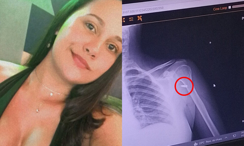 Mulher leva tiro de raspão e só descobre quatro horas depois