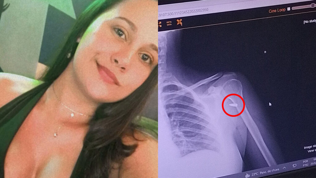 Mulher leva tiro de raspão e só descobre quatro horas depois