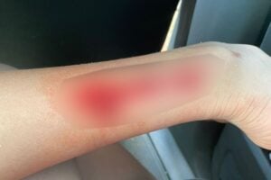 Criança de 11 anos é atacada por piranha no Lago das Brisas, em Buriti Alegre