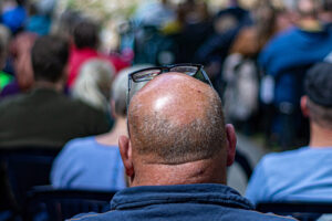 Pesquisa aponta remédios mais eficazes contra a calvície; veja resultado