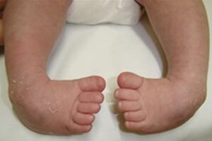 Tratamento cirúrgico deve ser reservado para as deformidades residuais e busca a completa resolução do quadro em um único procedimento