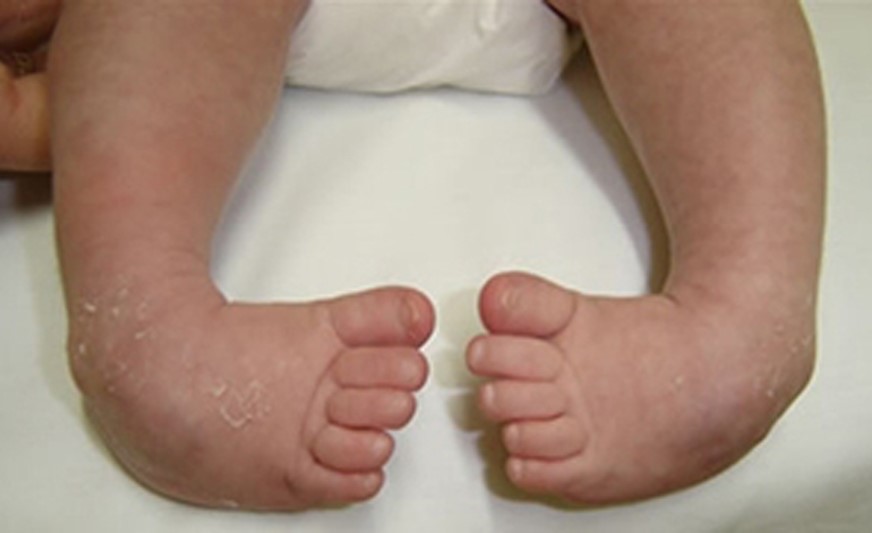 Tratamento cirúrgico deve ser reservado para as deformidades residuais e busca a completa resolução do quadro em um único procedimento