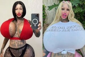 Influencer viciada em plásticas já gastou mais de R$ 500 mil em cirurgias