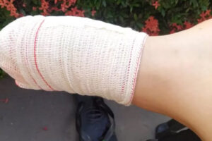 Turista perde parte do dedo em ataque de piranha, em Caldas Novas