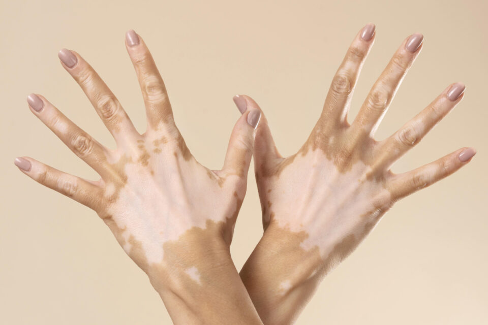 UFG usa planta do cerrado como base de pesquisa para tratamento de vitiligo