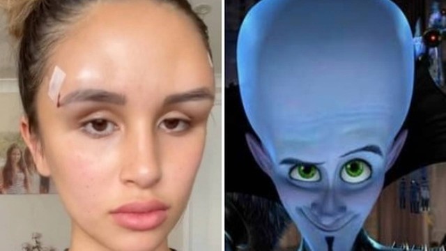 Na web, Jessie Carr foi comparada ao personagem Megamente. Cirurgia plástica malsucedida deforma rosto de modelo australiana; veja