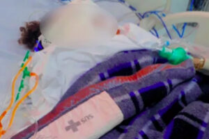 Bebê tem 80% do corpo queimado após queda de panela com água quente em Rio Verde (GO)